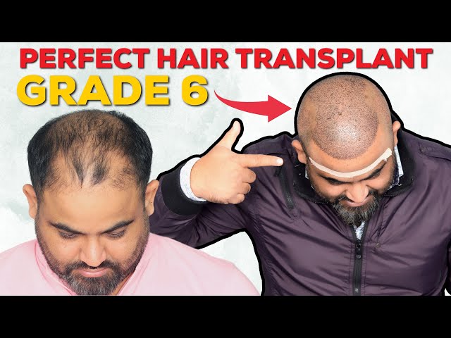 Hair Transplant Surgery clinic in Guwahati at affordable Cost