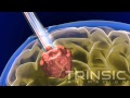 Neuroport medical animation