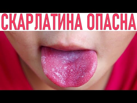 СКАРЛАТИНА У ДЕТЕЙ | Симптомы, лечение и диагностика