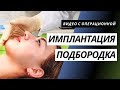 ИМПЛАНТАЦИЯ ПОДБОРОДКА | ЭНДОПРОТЕЗИРОВАНИЕ ПОДБОРОДКА | МЕНТОПЛАСТИКА КИЕВ | ПЛАСТИКА ПОДБОРОДКА