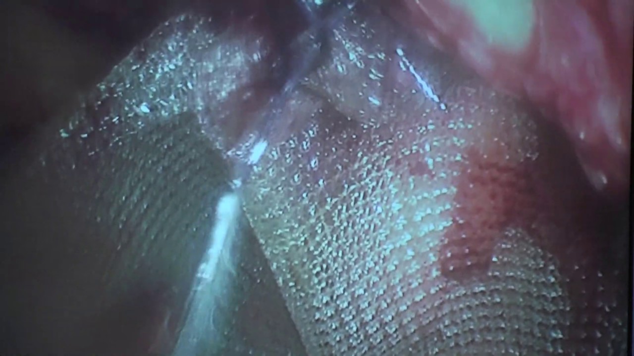 Herniorrafia inguino-escrotal direita por video / Right inguinal scrotal herniorrhaphy by video doutor estranho filme