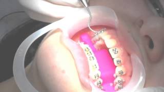 How To Put Braces ON (2015)(New Future Braces http://www.linkbucks.com/C074f How To Put Braces ON (2015) On this video, we will show the whole process of putting braces on. This is a ..., 2014-07-27T16:47:18.000Z)