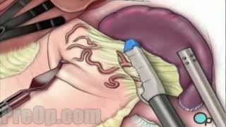 Spleen Removal Laparoscopic Splenectomy Patient Education