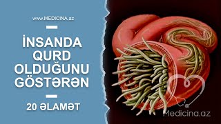 İnsanda qurd olduğunu göstərən 20 əlamət- Dəhşətli fəsadlar Resimi