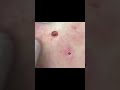 Slipped Right Out рџ Drpimplepopper Slipped Right Out рџ Drpimplepopper