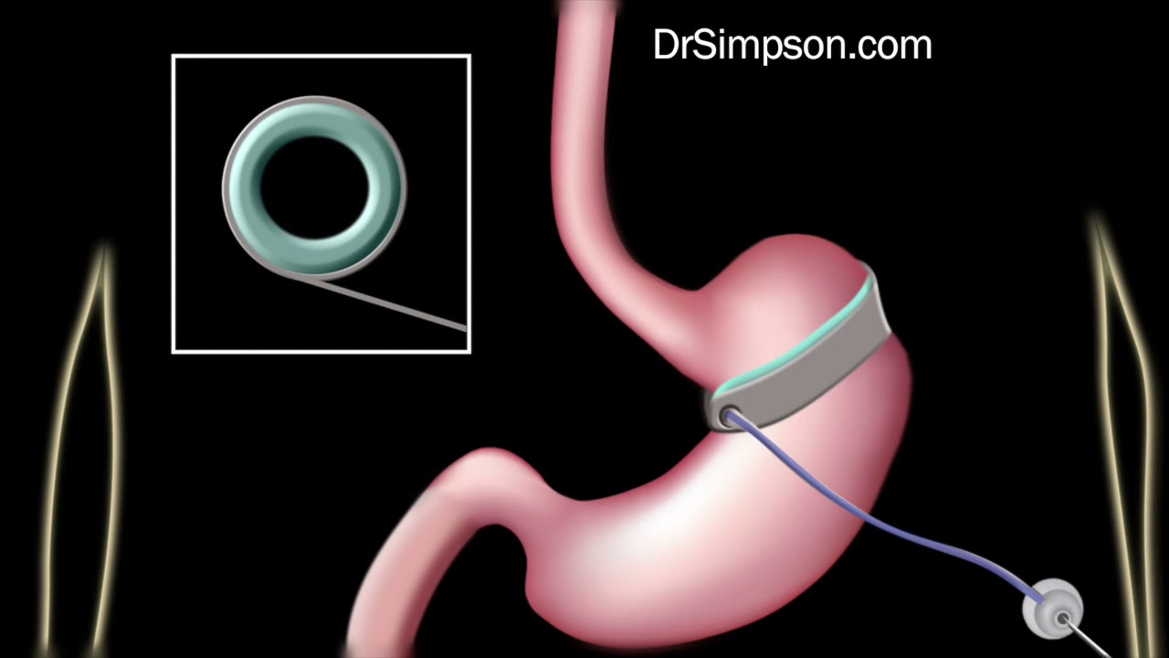 Endoscopic Weight Loss Procedures vs. Bariatric Surgery