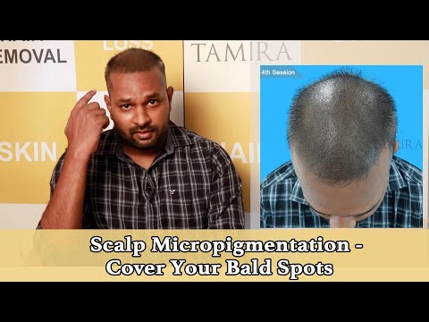 What is Scalp Micropigmentation? | Optima Hair