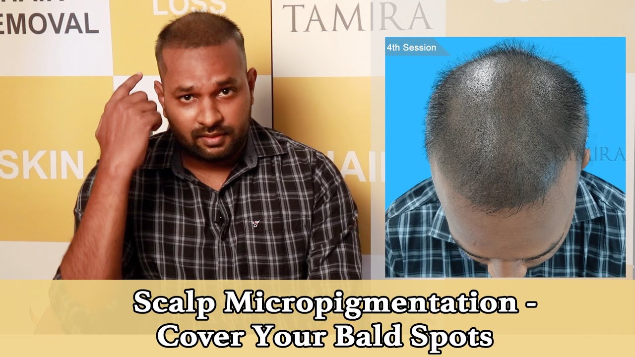 Who Is a Candidate for Micropigmentation  Got Scalp