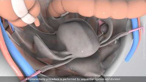 Vaginal hysterectomy