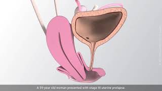 Vaginal hysterectomy