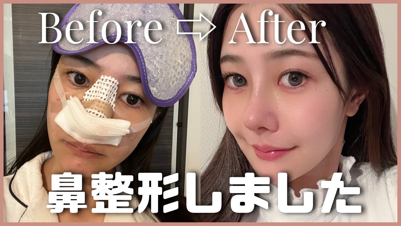 鼻整形ダウンタイムの全て🥺顔激変？QOL爆上がりした整形VLOG