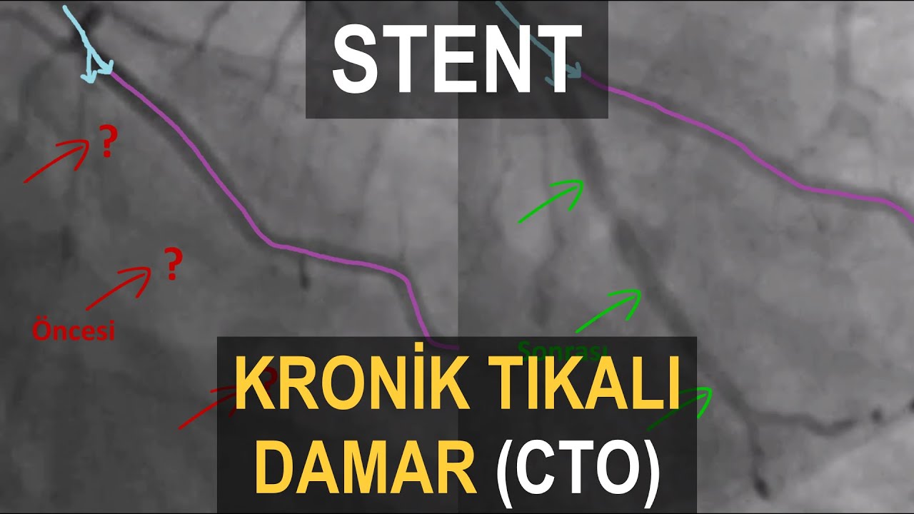 Stent or Bypass?