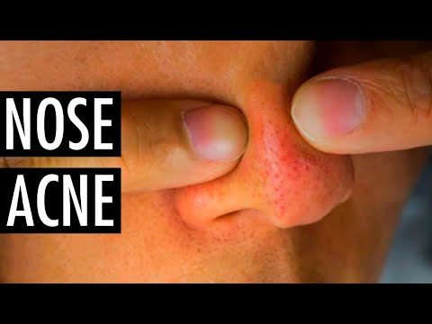 Video: How To Get Rid Of Pimples On The Nose