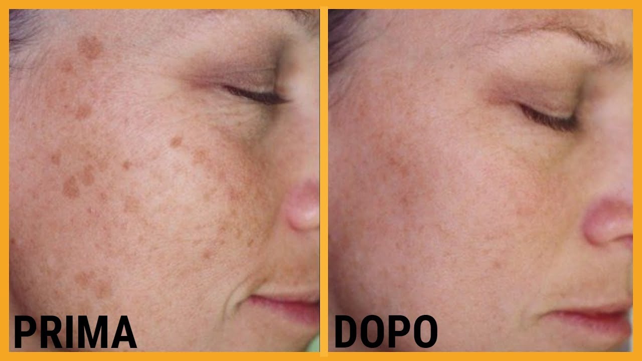 Come ELIMINARE le MACCHIE DAL VISO causate dai brufoli ♡ - YouTube