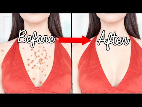 How To Get Rid Of BODY ACNE OVERNIGHT !!