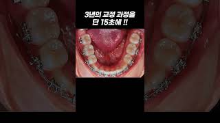 15초 안에 보여주는 3년 치아 교정의 변화 !
