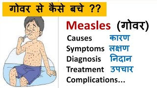Measles : Causes, Symptoms, Treatment, Vaccination | Rubella vs Rubeola | Red measles