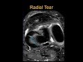 TMT: MRI Knee Meniscal Tears by Dr Srijita Ghosh