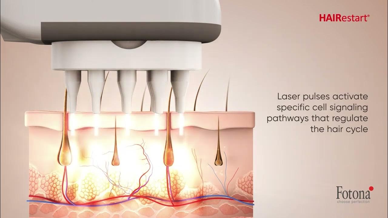 HAIRestart Non Invasive Laser Stimulation Of Hair Growth Fotona Hair hairestart-non-invasive-laser-stimulation-of-hair-growth-fotona-hair