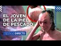 El Hombre Con Piel de Pescado: ¿Qué tan doloroso es tener escamas en todo el cuerpo?