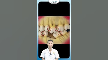 Điều Gì Xảy Ra Khi Mất Răng | Bác Sĩ Yên
