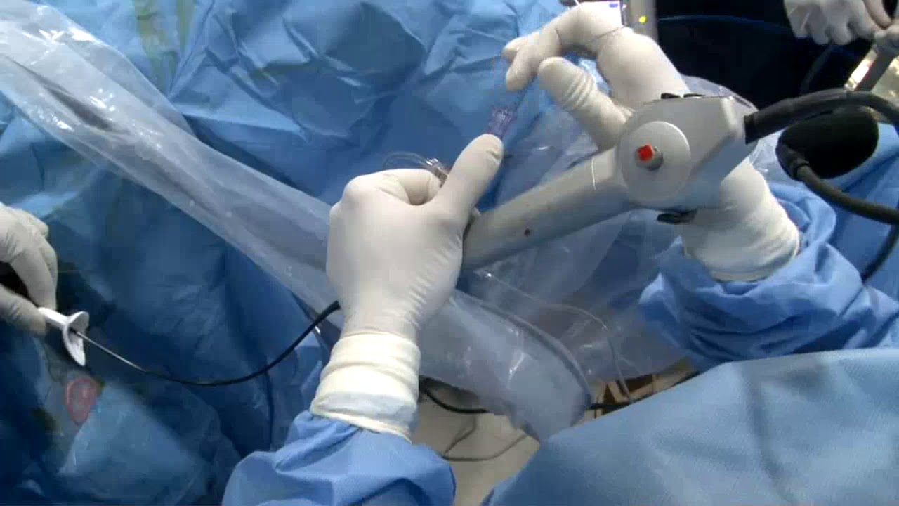 Holmium laser lithotripsy for secondary stone by Dr V.Chandra Mohan