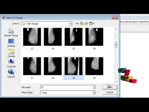 Final Year Projects | Improvement for detection of microcalcifications through