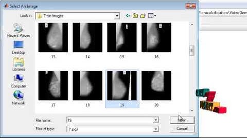 Final Year Projects | Improvement for detection of microcalcifications through