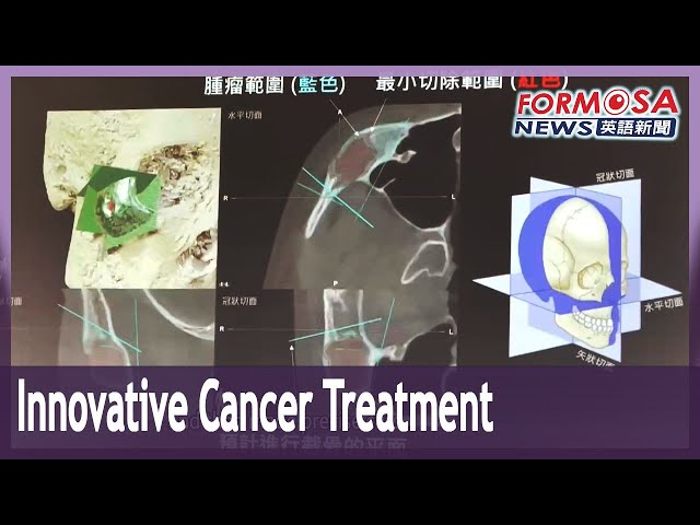Hospital uses innovative 3D printing to treat a child with a rare form of cancer｜Taiwan News