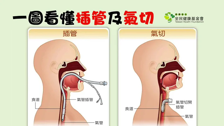 一图看懂插管、气切的差别　原来这样选对病人比较好 - 天天要闻