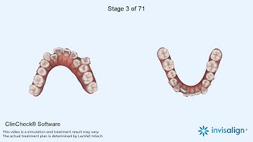 Clincheck khách hàng Lê Thanh Hải - Niềng răng móm bằng invisalign.