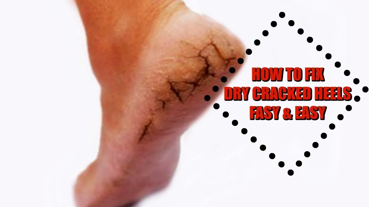 HOW TO FIX DRY CRACKED HEELS FAST 