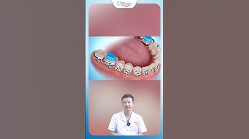 Nâng Khớp Cắn Niềng Răng | Bác Sĩ Yên