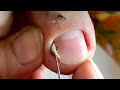 HOW TO CUT THICK TOENAILS - Toenail Cleaning Satisfying #992