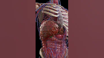 Cirrhosis Liver Under Siege 3dmodel Meded Anatomy 
