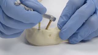 How to  Hands on using Angled Mini Conical Abutments
