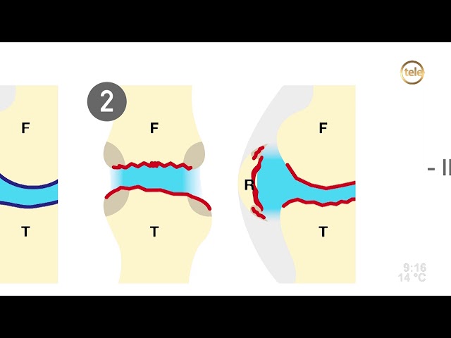 Clínica Jakter - NUEVOS TRATAMIENTOS PARA LA ARTROSIS DE RODILLA Cuando  hablamos de artrosis, hacemos referencia a un proceso degenerativo, de  desgaste de las articulaciones, que comienza básicamente en los cartílagos  articulares