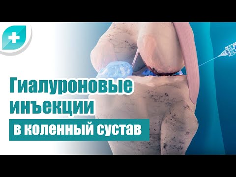 Гиалуроновые инъекции в коленный сустав