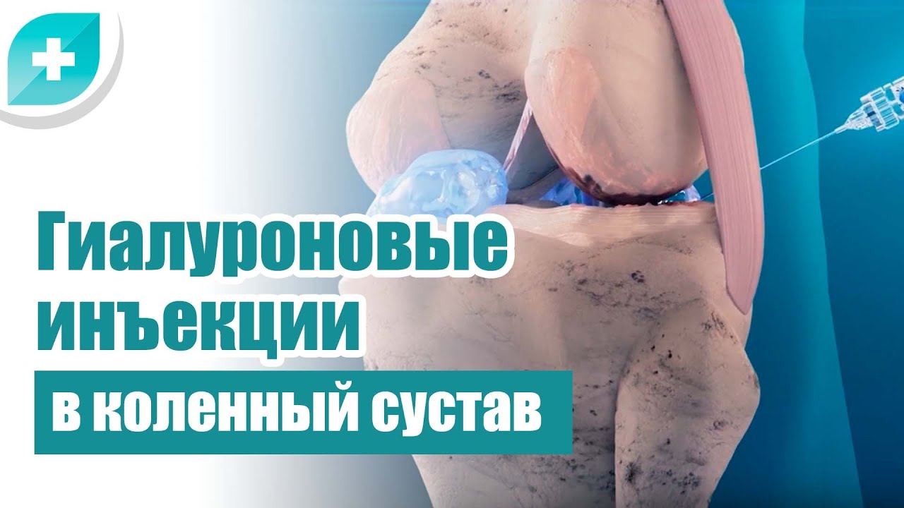 Гиалуроновые инъекции в коленный сустав
