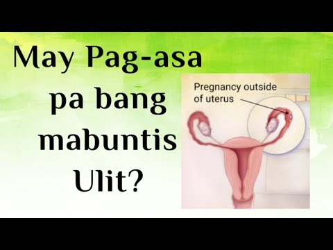 Video: Posible Bang Mabuntis Pagkatapos Ng Isang Ectopic Na Pagbubuntis