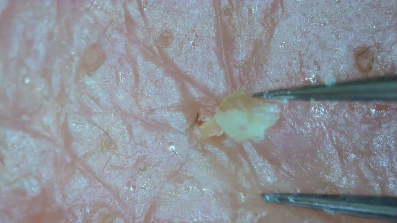 0217 keratin plug removal cheek YouTube