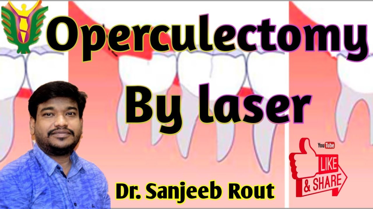 Operculectomy By Laser Dr Sanjeeb Rout Youtube