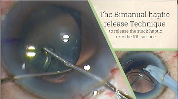 The Bimanual haptic release technique - to release the stuck haptic from the Optic surface