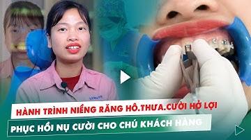 Hành Trình Niềng Răng Hô, Thưa Đầy Thử Thách | Cận Cảnh Gắn Mắc Cài & Chia Sẻ Cảm Nhận