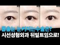 돌출눈 눈커지는수술? 시선성형외과 뒤밑트임으로!