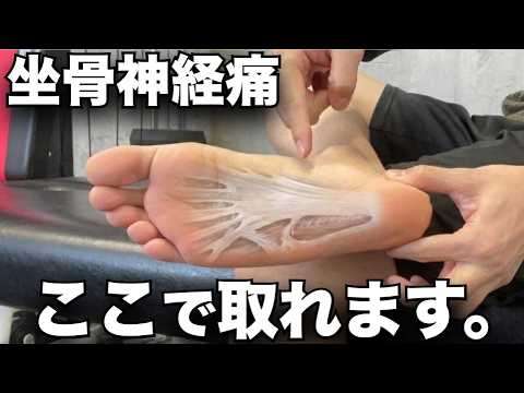 How to cure sciatica yourself] The answer is the soles of your