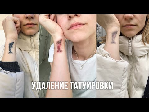 УДАЛЕНИЕ ТАТУИРОВКИ | Karolina K