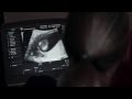 Advanced early pregnancy scan