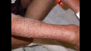 Muckle Wells Syndrome MWS genetic autoinflammatory disorder ; Causes, Symptoms, Key features, Treat