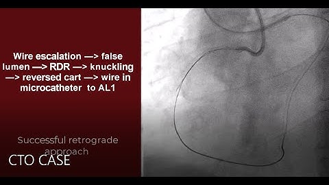 CTO CASE : Reverse cart technique with knuckling